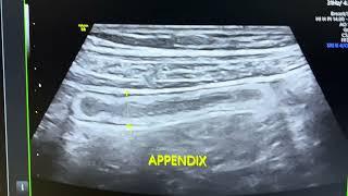 Chronic mucocele of appendix picture . H/o apendicitis 1 yrs back. Chronic on off pain in RIF