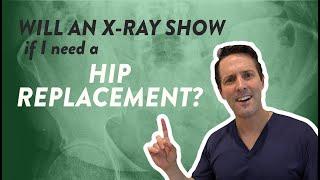 Will an x-ray show if I need a hip replacement?