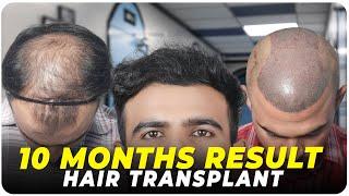 Hair Transplant in Hyderabad | Best Results & Cost of Hair Transplant in Hyderabad