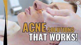 ACNE Solutions that Works!