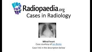 Mitral heart (Radiopaedia.org) Cases in Radiology