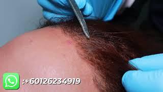 SMART FUE Hair Restoration Journey: After 9 Months | Glojas Aesthetic Clinic