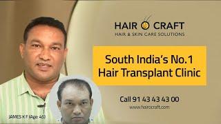 Hair O Craft -Hair Transplant in Bangalore