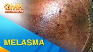 MELASMA: Cause and Treatment Explained by Dermatologist