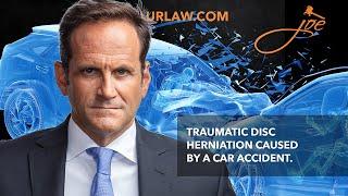 Zarzaur Law, P.A. TV: How Does a Car Accident Cause a Disc Herniation?