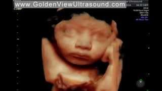 HD live Ultrasound at 35 weeks from GoldenView Ultrasound