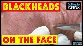 Short but Sweet Blackhead Extractions with Dr Pimple Popper