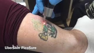 UberSkin PicoSure Laser Tattoo Removal