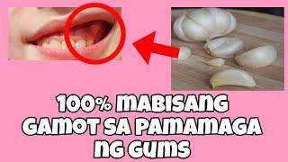 MABISANG GAMOT sa pamamaga ng gums/gilagid.