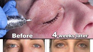 Plasma Pen Fibroblast Treatment Lower & Upper Eyelids - BEFORE & AFTER Transformation (2022)