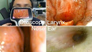ENT Endoscopy |Ear Nose Throat Examination | Using BESDATA Handheld Portable Otoscope
