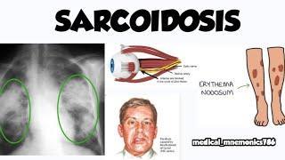 Sarcoidosis - causes, symptoms, diagnosis, treatment, pathology
