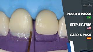 Diastema and Incisal Increase I Diastema y Alargamiento Incisal I Diastema e Aumento Incisal