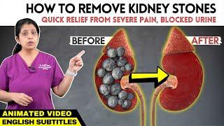 Animation - Kidney Stone Pain Relief | சிறுநீரக கற்கள் - பயங்கர வலியிலிருந்து விடுபட வழிகள்