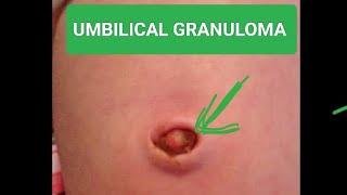 what is umbilical granuloma??? how to cure it ???