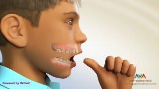 Orthodontic Treatment for Thumb Sucking - Habit Breaker Appliance