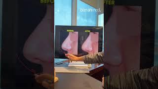 Rhinoplasty Surgery on Thick Skin | Rhinoplasty Before and After by Dr. Bashar Bizrah, Dubai/London