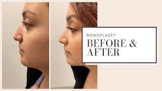 Plastic Surgery Before & After | Rhinoplasty | ESKMD NYC