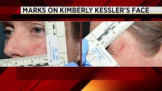 Photos show bruises, scratches on woman charged in hairstylist's murder