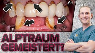 Neue Zähne für Patientin! Zahnkronen und Veneers lassen sie wieder strahlen!