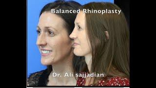 A wonderful Septorhinoplasy by Dr.  Ali Sajjadian!| Nose job|Rhinoplasty in Newport Beach