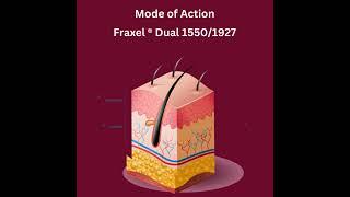 Fraxel Mode of Action