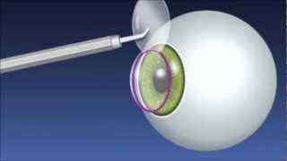 What Is LASIK Eye Surgery and How Does it Work?