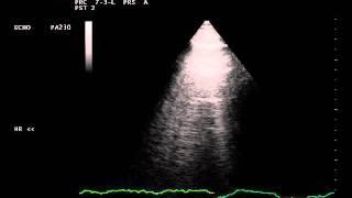 Pleural ultrasound