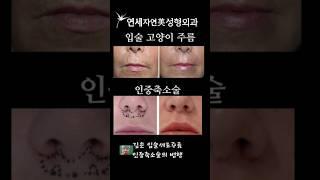 인중축소술과 입술세로주름교정 #연세자연미성형 #입술고양이주름잘하는곳 #인중축소술 #위입술길이축소 #신촌성형외과 #홍대성형외과 #은평성형외과 #마포성형외과