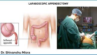 LAPAROSCOPIC APPENDECTOMY | DR SHIVANSHU MISRA