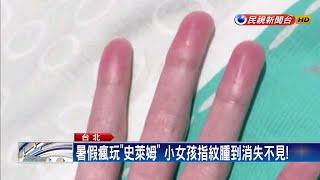 手指腫到像香腸！竟是小玩具「史萊姆」作祟－民視新聞