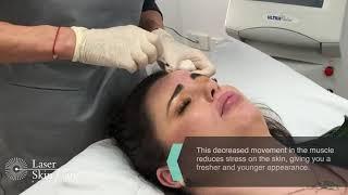 Wrinkle Relaxer Treatment at Laser Skin Care