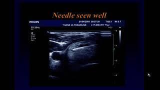 Ultrasound Guided Interventions