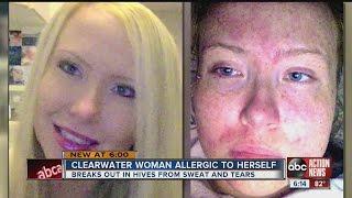 Julie Reid, 28, suffers from Cholinergic Urticaria, a hypersensitive skin condition causing hives