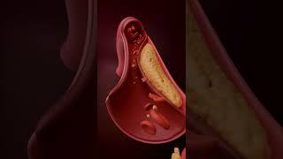 किस तरह आता है हार्ट अटैक ?How Does a Heart Attack Happen? Step-by-Step Explanation!