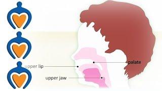 Orofacial cleft (schisis) - What is an orofacial cleft?