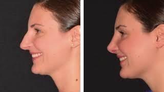 Rhinoplasty Before & After Compilation