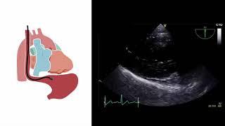 Mastering important TEE views (transesophageal echocardiography)