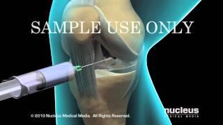 Knee Arthroscopy