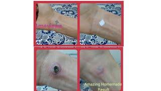 Simple way to remove tatoo at home . Acidic 100% Formula