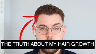 I Got PRP Injections For Hair Loss Heres What Happened | PRP Results Before And After