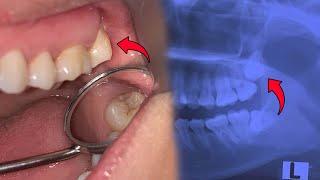 Removal of upper wisdom tooth that was embedded and not visible at all.