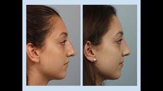 Teenage Female Video of Rhinoplasty by Dr Edwin Williams