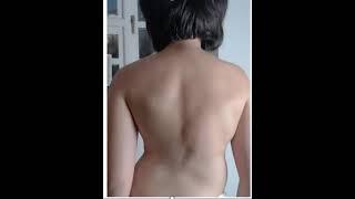 Session 8 of the Better-Than-Surgery ASMI Treatment for Scoliosis