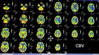 Video 2 of 3:  How to Interpret a Brain CT Perfusion Scan for acute stroke