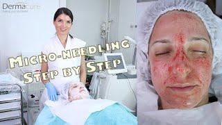 MICRONEEDLING/SKIN-NEEDLING/| Acne Scars, Wrinkles, Large Pores,Pigmentation, Fine lines,