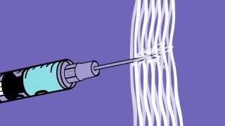 Bleach Works (how to safely clean a used syringe with bleach tablets)