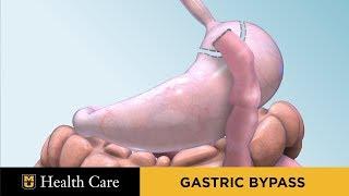 Bariatric Surgery Seminar: Gastric Bypass