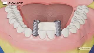 Video Tutorial for All-on-6 to know how 6 Dental Implants are used to replace missing teeth.