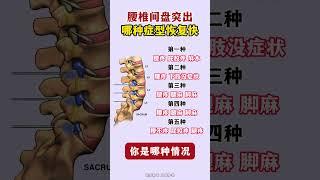 腰椎间盘突出 腰疼腿疼 骨科专家李俊海 腰椎椎管狭窄